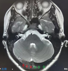 孕妈妈颈痛不是颈椎病？这些症状不容小觑