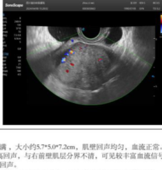 胎盘植入不要慌，“不开刀流血”打赢子宫保卫战