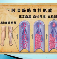 警惕！沉默的“杀手”——静脉血栓栓塞症（VTE）的预防